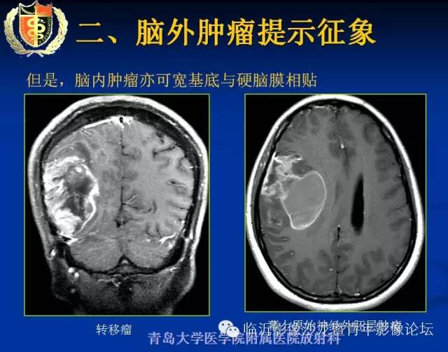 【PPT】颅内肿瘤的影像学定位诊断