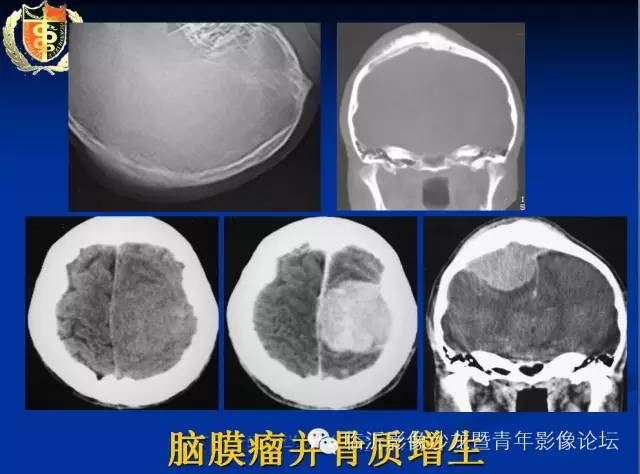 【PPT】颅内肿瘤的影像学定位诊断
