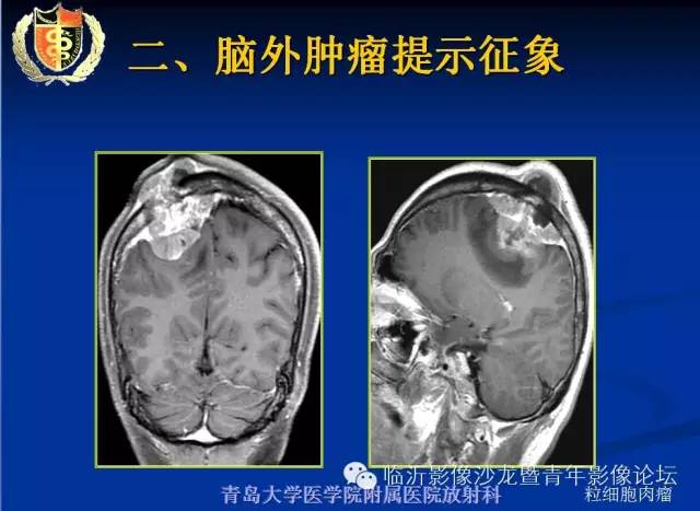 【PPT】颅内肿瘤的影像学定位诊断