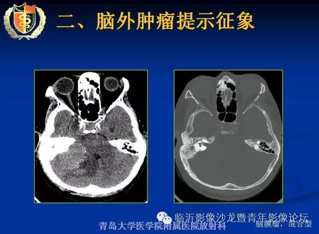 【PPT】颅内肿瘤的影像学定位诊断
