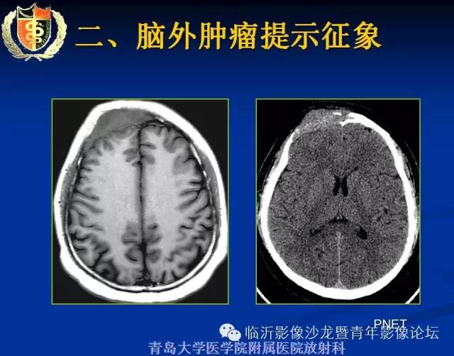 【PPT】颅内肿瘤的影像学定位诊断
