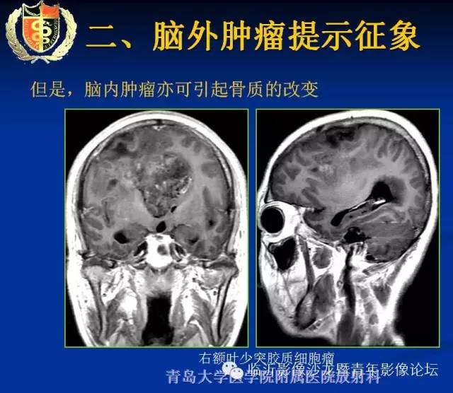 【PPT】颅内肿瘤的影像学定位诊断
