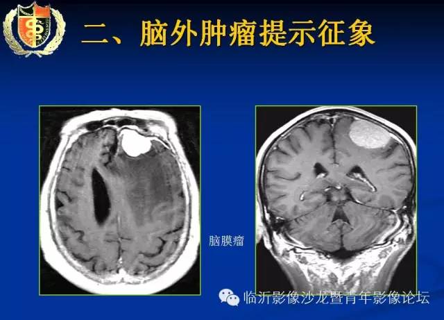 【PPT】颅内肿瘤的影像学定位诊断