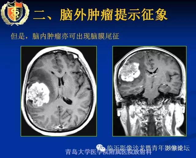 【PPT】颅内肿瘤的影像学定位诊断