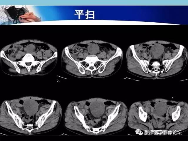 【病例】小肠系膜脂肪肉瘤1例CT影像表现 【病例】小肠系膜脂肪肉瘤1例CT影像表现