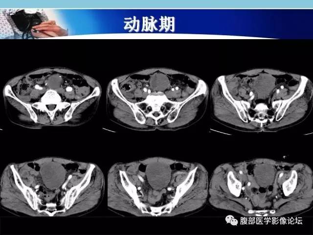 【病例】小肠系膜脂肪肉瘤1例CT影像表现 【病例】小肠系膜脂肪肉瘤1例CT影像表现