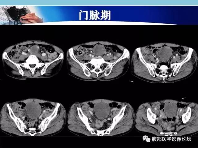 【病例】小肠系膜脂肪肉瘤1例CT影像表现 【病例】小肠系膜脂肪肉瘤1例CT影像表现