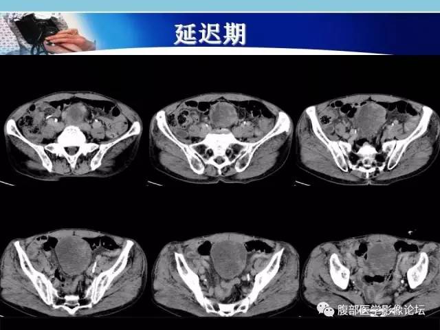 【病例】小肠系膜脂肪肉瘤1例CT影像表现 【病例】小肠系膜脂肪肉瘤1例CT影像表现