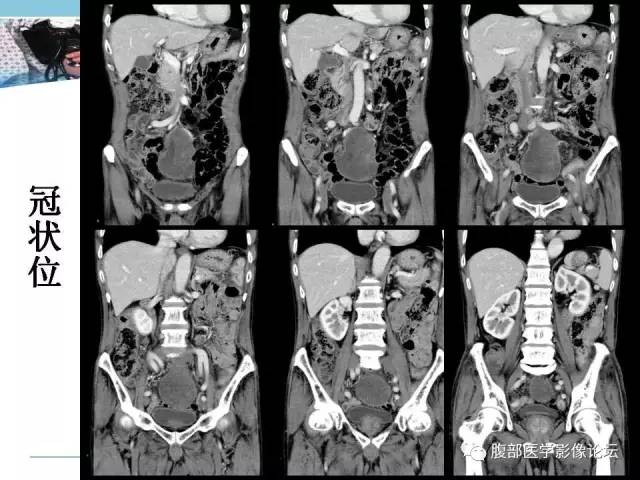 【病例】小肠系膜脂肪肉瘤1例CT影像表现 【病例】小肠系膜脂肪肉瘤1例CT影像表现