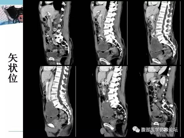 【病例】小肠系膜脂肪肉瘤1例CT影像表现 【病例】小肠系膜脂肪肉瘤1例CT影像表现