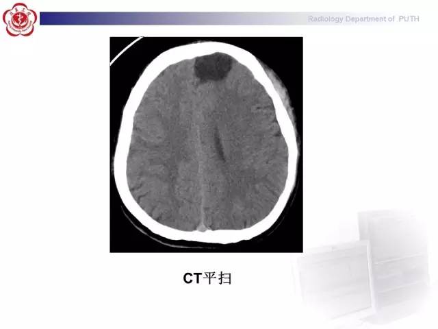 【病例】胚胎发育不良性神经上皮瘤1例CT及MR影像诊断与鉴别