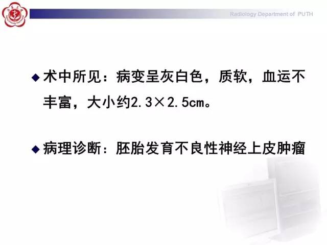 【病例】胚胎发育不良性神经上皮瘤1例CT及MR影像诊断与鉴别