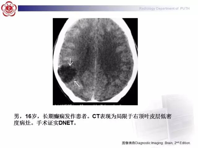 【病例】胚胎发育不良性神经上皮瘤1例CT及MR影像诊断与鉴别