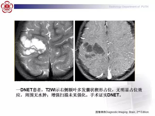 【病例】胚胎发育不良性神经上皮瘤1例CT及MR影像诊断与鉴别