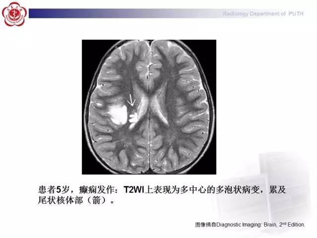 【病例】胚胎发育不良性神经上皮瘤1例CT及MR影像诊断与鉴别