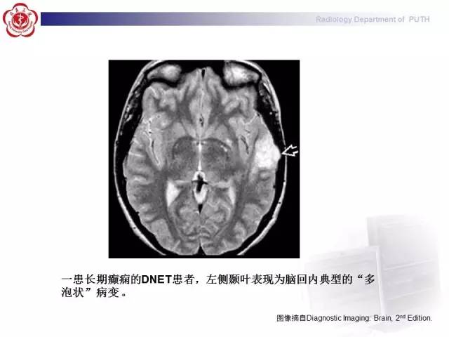 【病例】胚胎发育不良性神经上皮瘤1例CT及MR影像诊断与鉴别