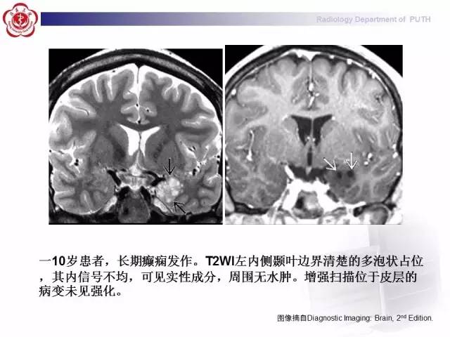 【病例】胚胎发育不良性神经上皮瘤1例CT及MR影像诊断与鉴别