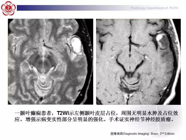 【病例】胚胎发育不良性神经上皮瘤1例CT及MR影像诊断与鉴别