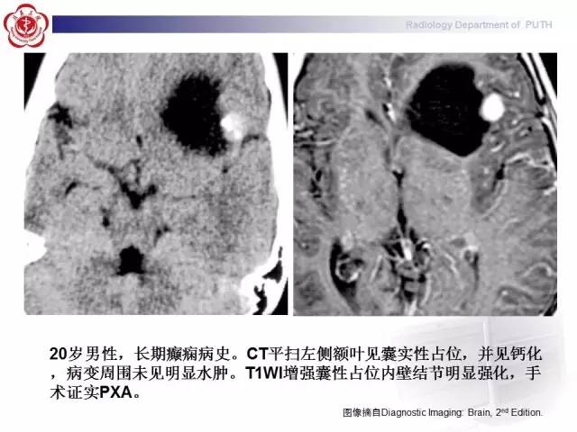 【病例】胚胎发育不良性神经上皮瘤1例CT及MR影像诊断与鉴别