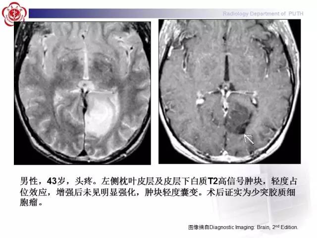 【病例】胚胎发育不良性神经上皮瘤1例CT及MR影像诊断与鉴别
