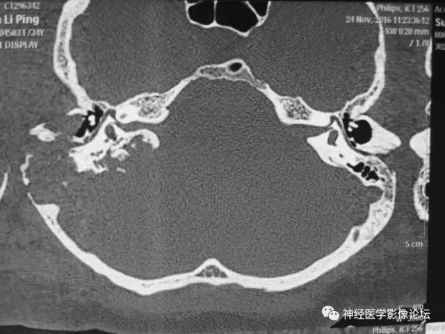 【病例】右侧内淋巴囊瘤1例CT及MR