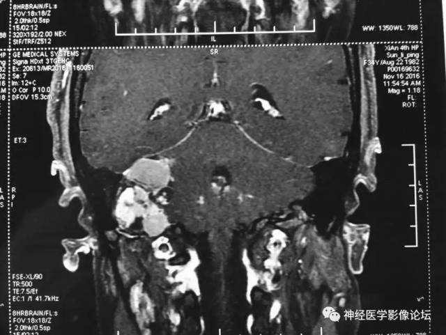 【病例】右侧内淋巴囊瘤1例CT及MR