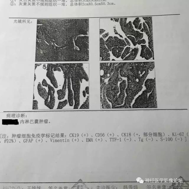 【病例】右侧内淋巴囊瘤1例CT及MR