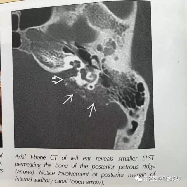 【病例】右侧内淋巴囊瘤1例CT及MR