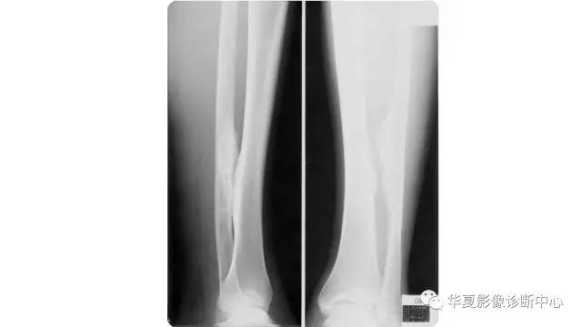 【病例】腓骨骨软骨瘤1例X线CT及MR