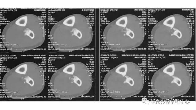 【病例】腓骨骨软骨瘤1例X线CT及MR