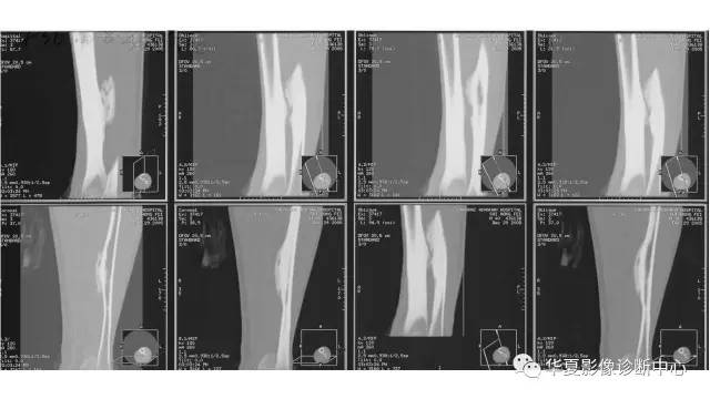【病例】腓骨骨软骨瘤1例X线CT及MR