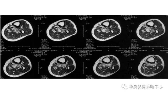 【病例】腓骨骨软骨瘤1例X线CT及MR