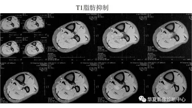 【病例】腓骨骨软骨瘤1例X线CT及MR