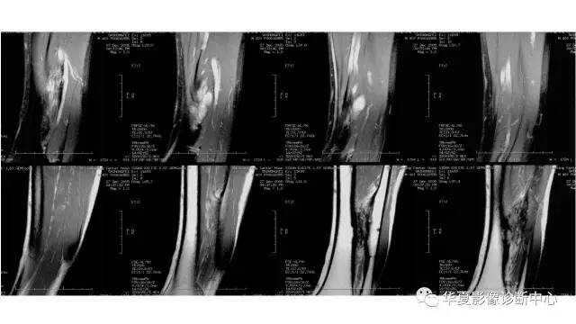 【病例】腓骨骨软骨瘤1例X线CT及MR