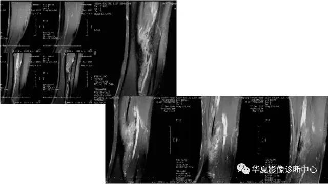 【病例】腓骨骨软骨瘤1例X线CT及MR