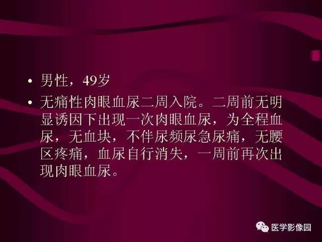 【病例】肾脏恶性纤维组织细胞瘤1例CT影像表现