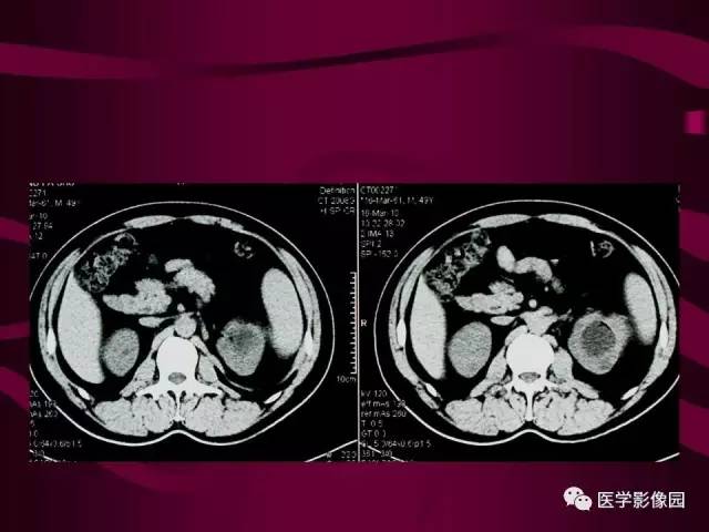 【病例】肾脏恶性纤维组织细胞瘤1例CT影像表现 【病例】肾脏恶性纤维组织细胞瘤1例CT影像表现