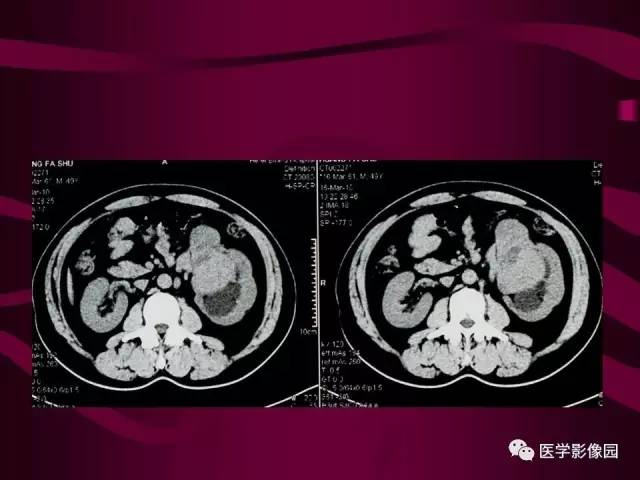 【病例】肾脏恶性纤维组织细胞瘤1例CT影像表现 【病例】肾脏恶性纤维组织细胞瘤1例CT影像表现