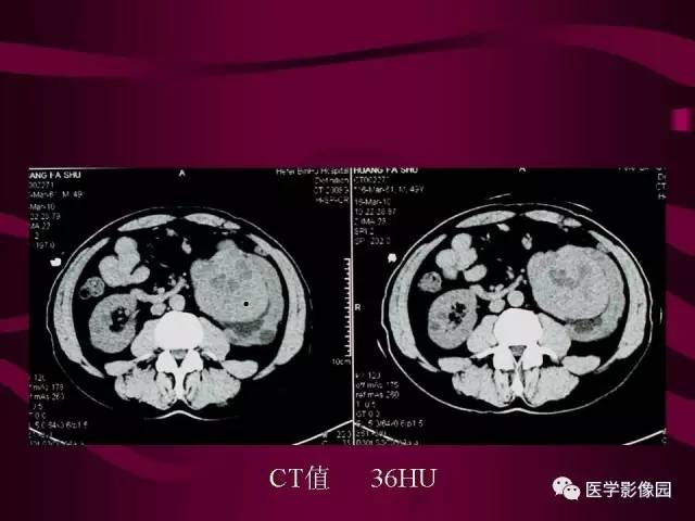 【病例】肾脏恶性纤维组织细胞瘤1例CT影像表现 【病例】肾脏恶性纤维组织细胞瘤1例CT影像表现