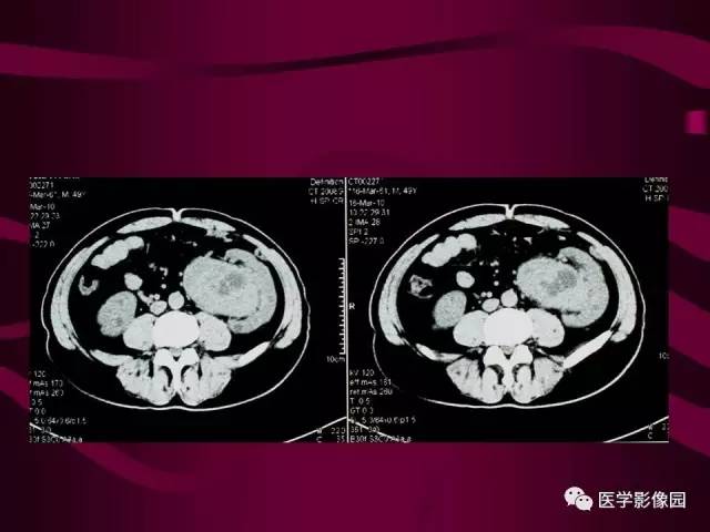 【病例】肾脏恶性纤维组织细胞瘤1例CT影像表现 【病例】肾脏恶性纤维组织细胞瘤1例CT影像表现
