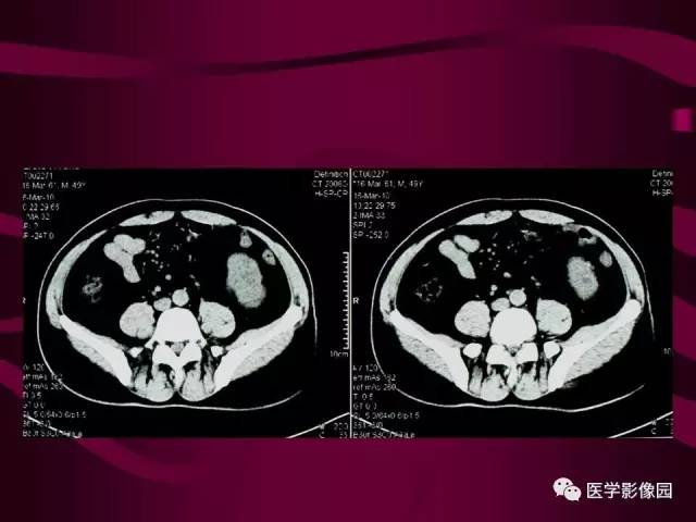 【病例】肾脏恶性纤维组织细胞瘤1例CT影像表现 【病例】肾脏恶性纤维组织细胞瘤1例CT影像表现