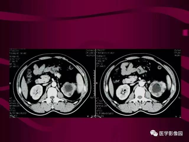 【病例】肾脏恶性纤维组织细胞瘤1例CT影像表现 【病例】肾脏恶性纤维组织细胞瘤1例CT影像表现
