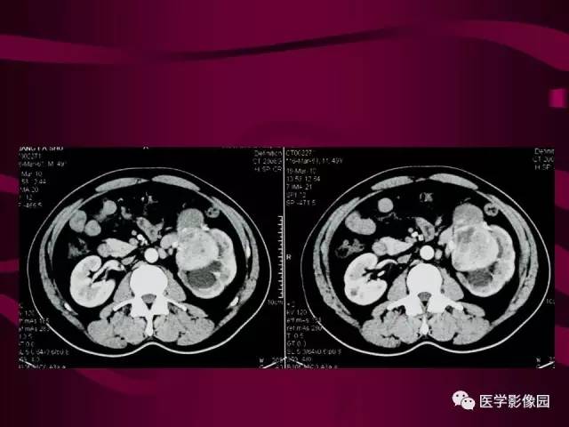 【病例】肾脏恶性纤维组织细胞瘤1例CT影像表现 【病例】肾脏恶性纤维组织细胞瘤1例CT影像表现