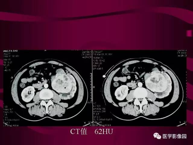 【病例】肾脏恶性纤维组织细胞瘤1例CT影像表现 【病例】肾脏恶性纤维组织细胞瘤1例CT影像表现