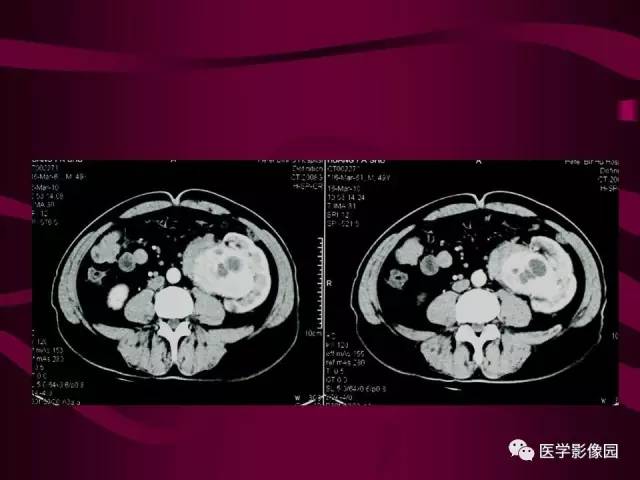 【病例】肾脏恶性纤维组织细胞瘤1例CT影像表现 【病例】肾脏恶性纤维组织细胞瘤1例CT影像表现
