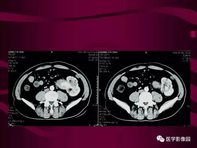 【病例】肾脏恶性纤维组织细胞瘤1例CT影像表现 【病例】肾脏恶性纤维组织细胞瘤1例CT影像表现