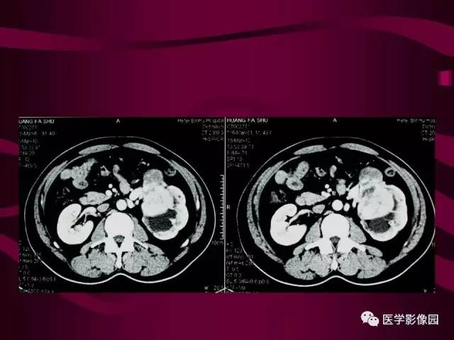【病例】肾脏恶性纤维组织细胞瘤1例CT影像表现 【病例】肾脏恶性纤维组织细胞瘤1例CT影像表现