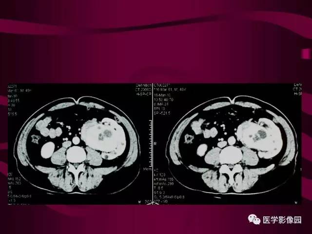 【病例】肾脏恶性纤维组织细胞瘤1例CT影像表现 【病例】肾脏恶性纤维组织细胞瘤1例CT影像表现