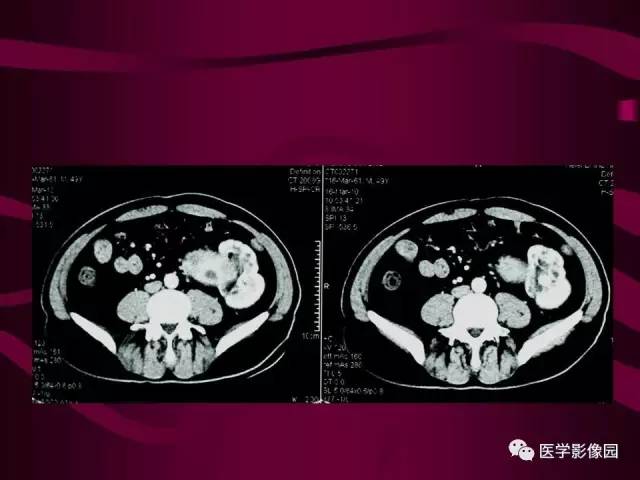 【病例】肾脏恶性纤维组织细胞瘤1例CT影像表现 【病例】肾脏恶性纤维组织细胞瘤1例CT影像表现