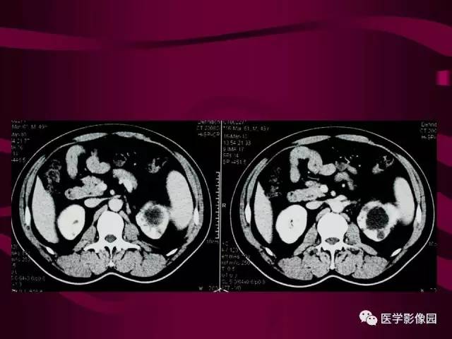 【病例】肾脏恶性纤维组织细胞瘤1例CT影像表现 【病例】肾脏恶性纤维组织细胞瘤1例CT影像表现